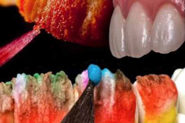 Minimally Invasive Indirect Bonded Restorations THE DIGITAL UPGRADE